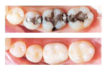 composite resin 3 surface filling globomd composite resin